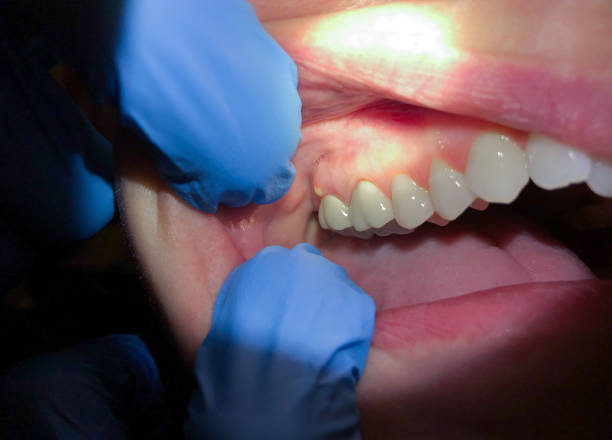 Best Emergency Care for Gum Disease in East Harwich, MA