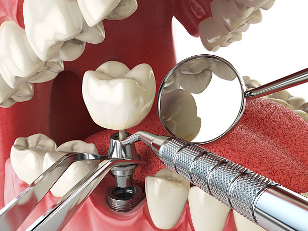 Best Broken or Chipped Tooth Repair in East Harwich, MA